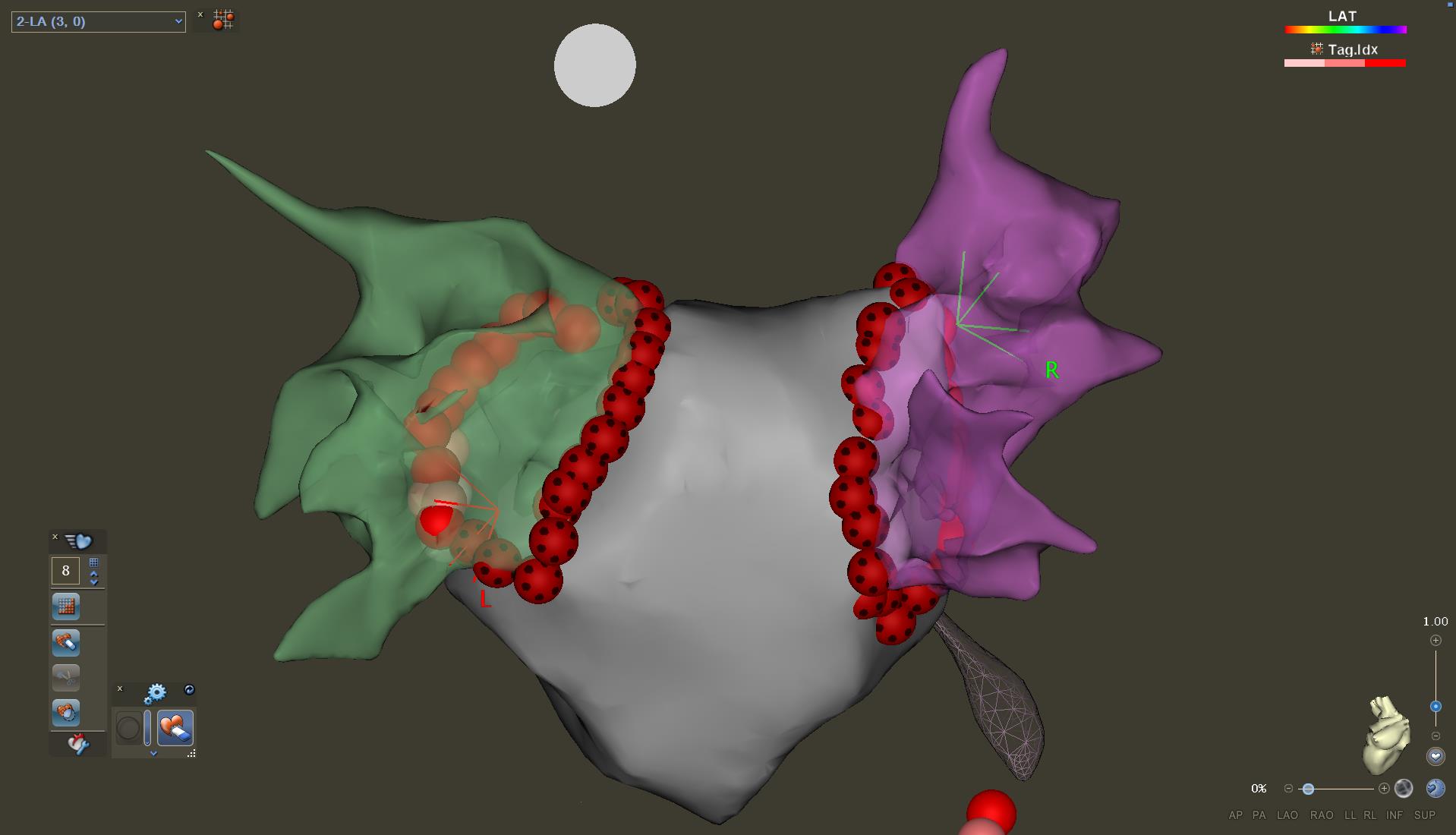 Ablation d
